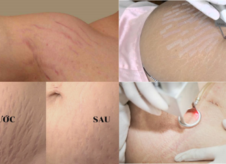 Công nghệ điều trị rạn da bằng laser chỉ có tại THẨM MỸ VIỆN XUÂN TRƯỜNG